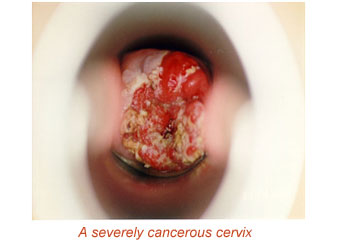 cancerous cervix
